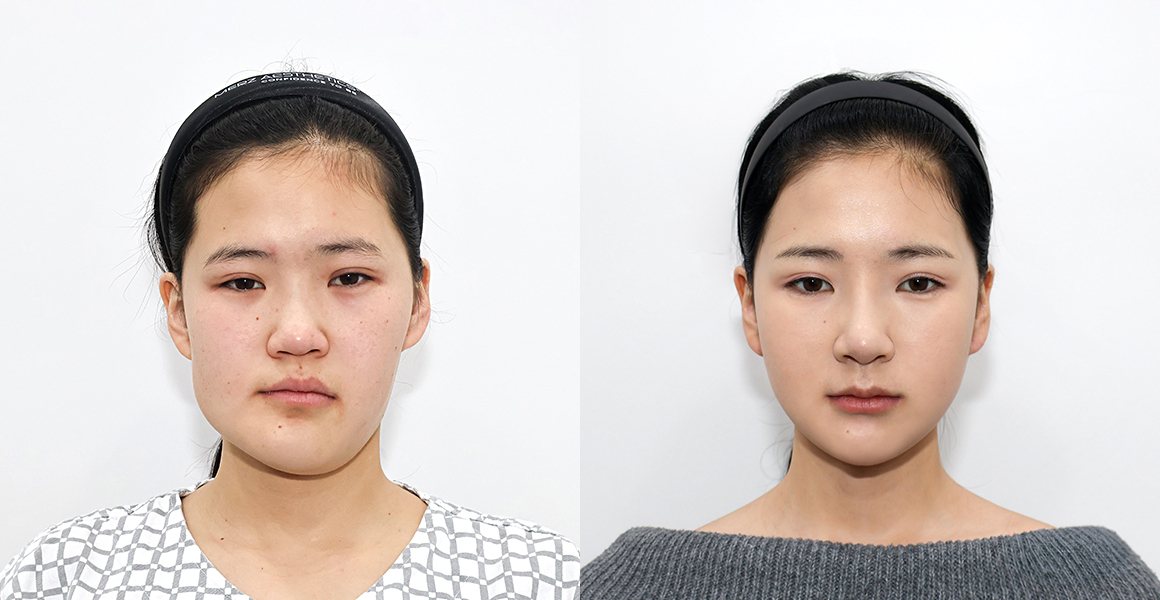 전후 사례 정면 — 수술 전·수술 후 3개월
