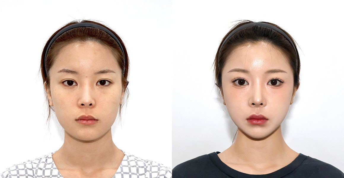 전후 사례 정면 — 수술 전·수술 후 1년