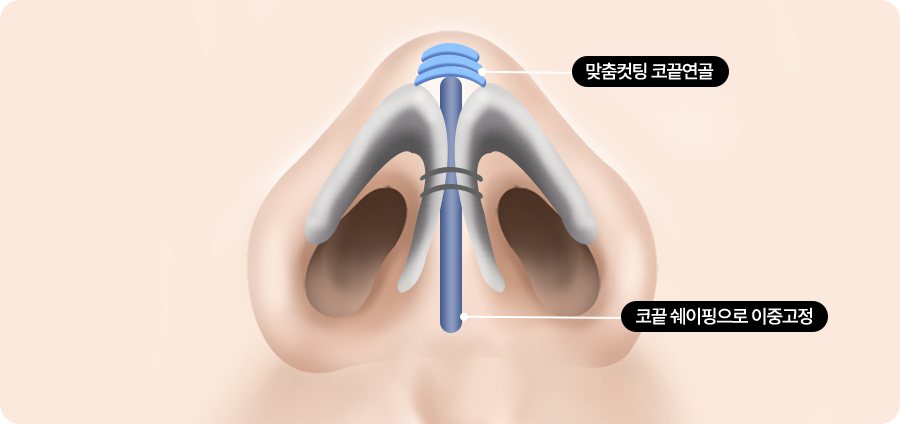 코 아래에서 본 코끝 연골 도식 — 라벨: 맞춤컷팅 코끝연골·코끝 쉐이핑으로 이중고정