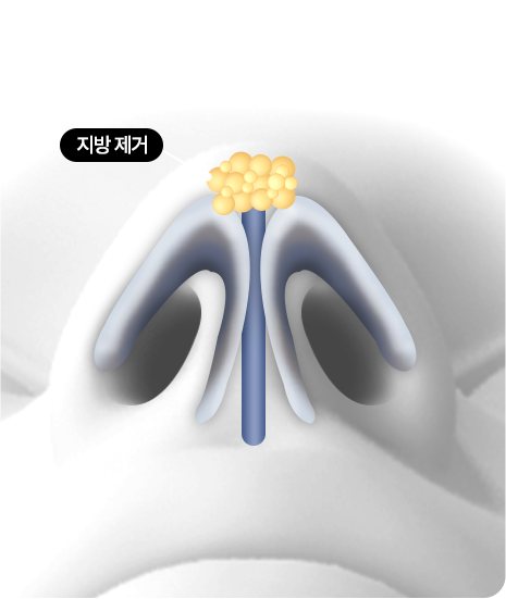 코 아래에서 본 코끝 도식, 코끝 지방 덩어리 표시 — 라벨: 지방 제거