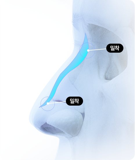 코 옆모습에 맞춤형 보형물이 밀착된 3D 일러스트 — 라벨: 밀착