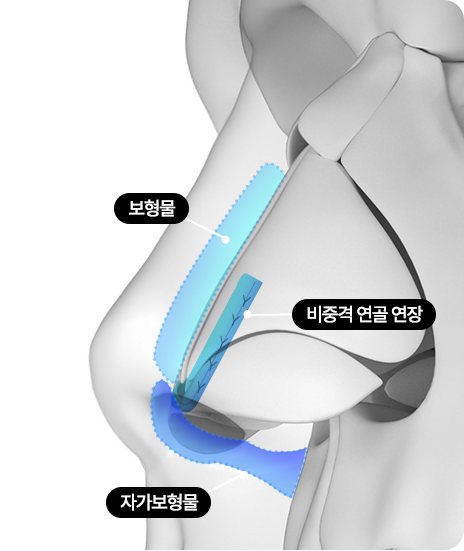 코 옆모습 단면 도식 — 라벨: 보형물·비중격 연골 연장·자가보형물