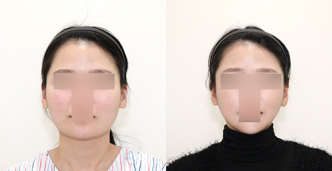 전후사진(정면, 왼쪽 수술 전·오른쪽 수술 후) — High-3D 광대, 비스포크 V라인, 1% 안면윤곽수술의 특별함