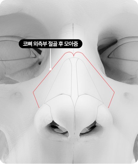 외측 절골술 도식 - 코뼈 외측부 절골 후 모아줌(빨간 점선)