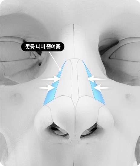 콧대 너비 줄이기 도식 - 콧등 너비 줄여줌(안쪽 화살표)