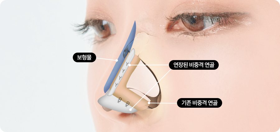 3중 비중격 연골 연장법 도식(보형물·연장된 비중격 연골·기존 비중격 연골)
