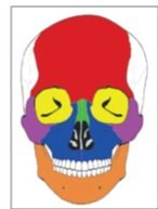 Figure 1: 단독 안면골 골절 부위를 색으로 구분한 두개골 정면 도식
