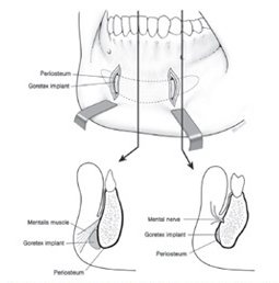 Fig. 1: 고어텍스 턱 보형물의 이중 평면(dual plane) 삽입 위치 도식(Periosteum·Goretex implant·Mentalis muscle·Mental nerve 표시)