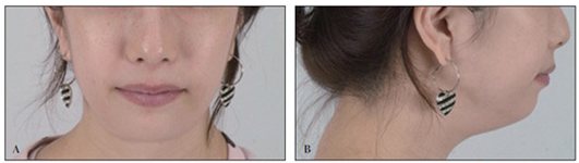Fig. 3 (A, B): 24세 여성 수술 전 정면·측면