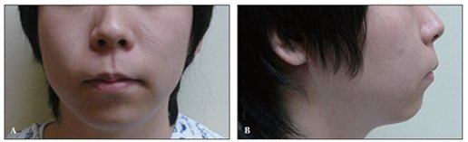 Fig. 4 (A, B): 20세 남성 수술 전 정면·측면