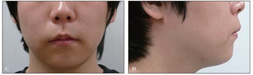 Fig. 4 (C, D): 20세 남성 수술 6개월 후 정면·측면