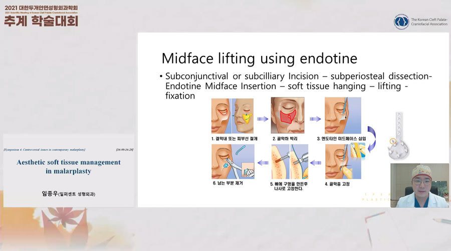 발표 화면: Midface lifting using endotine 슬라이드(수술 과정 도식)