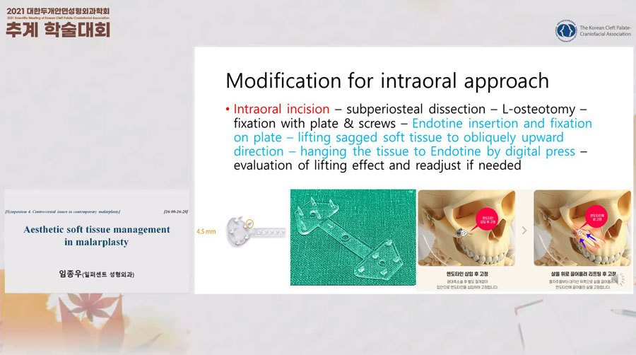 발표 화면: Modification for intraoral approach 슬라이드