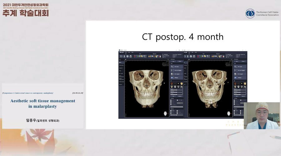 발표 화면: CT postop. 4 month(3D CT 두개골 정면 비교)