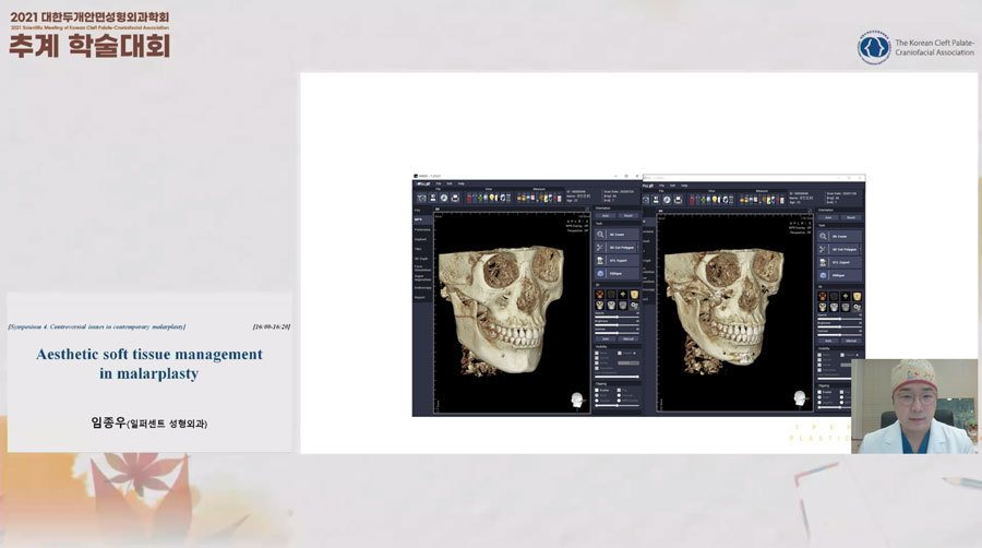 발표 화면: 3D CT 두개골 사선 비교