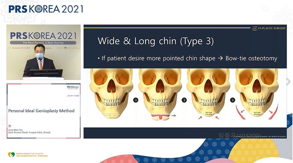 발표 화면: Type 3 Bow-tie osteotomy 두개골 그림