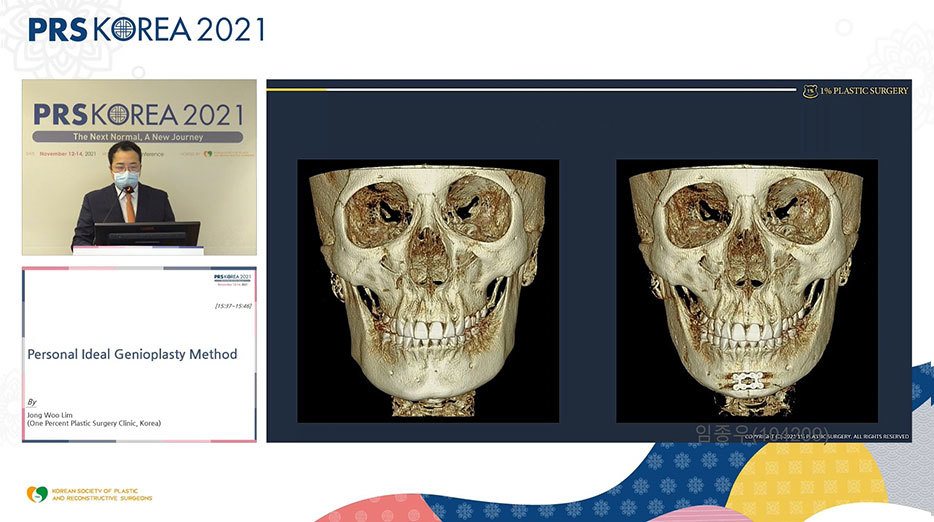 발표 화면: 3D CT 두개골 정면 전후 비교 1
