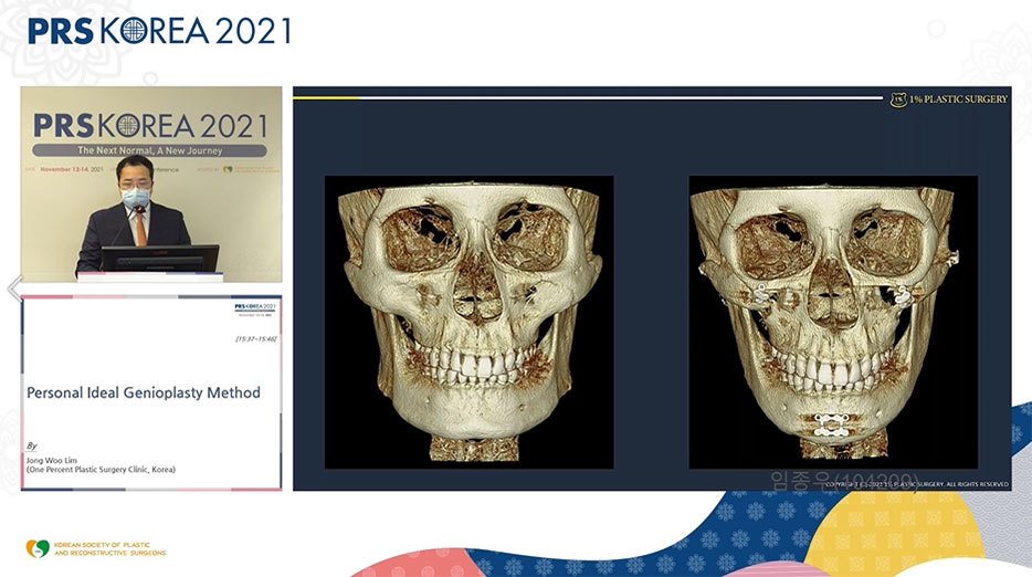 발표 화면: 3D CT 두개골 정면 전후 비교 2