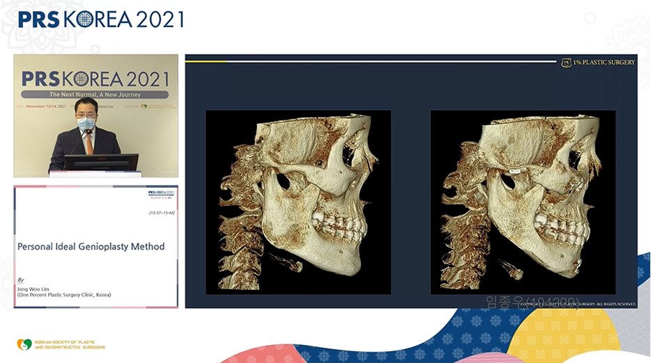발표 화면: 3D CT 두개골 측면 전후 비교 1