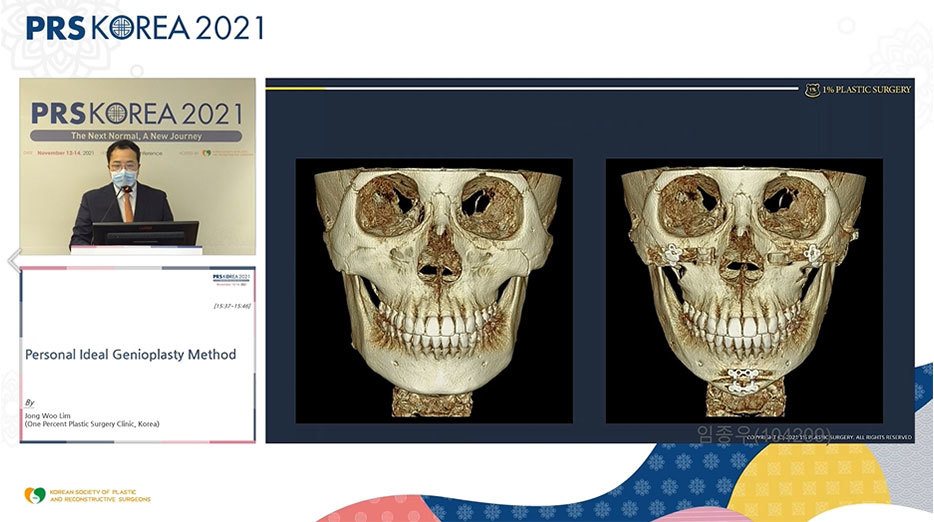 발표 화면: 3D CT 두개골 정면 전후 비교 3