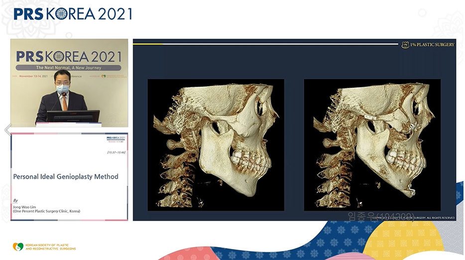 발표 화면: 3D CT 두개골 측면 전후 비교 2