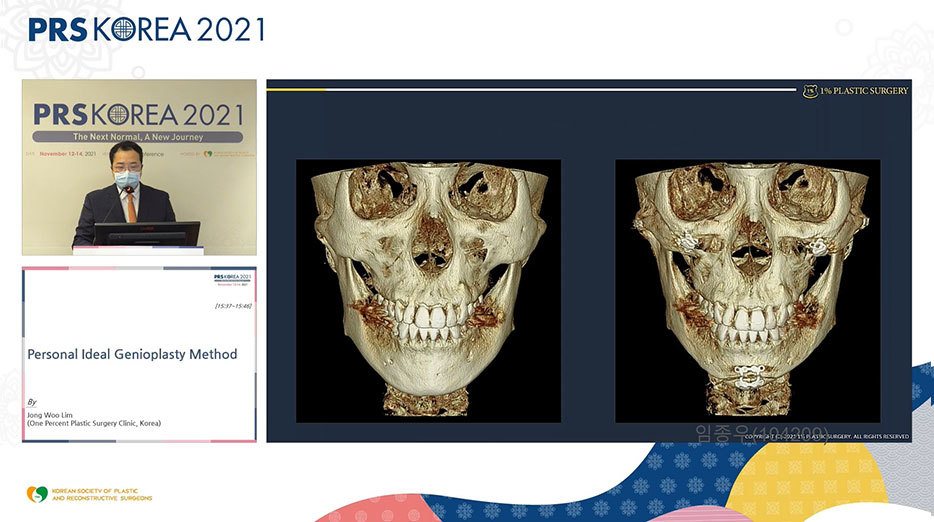 발표 화면: 3D CT 두개골 정면 전후 비교 4