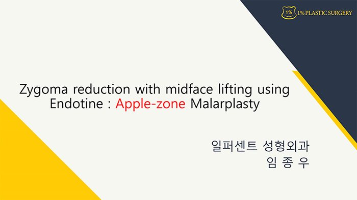 발표 슬라이드 표지 Zygoma reduction with midface lifting using Endotine : Apple-zone Malarplasty