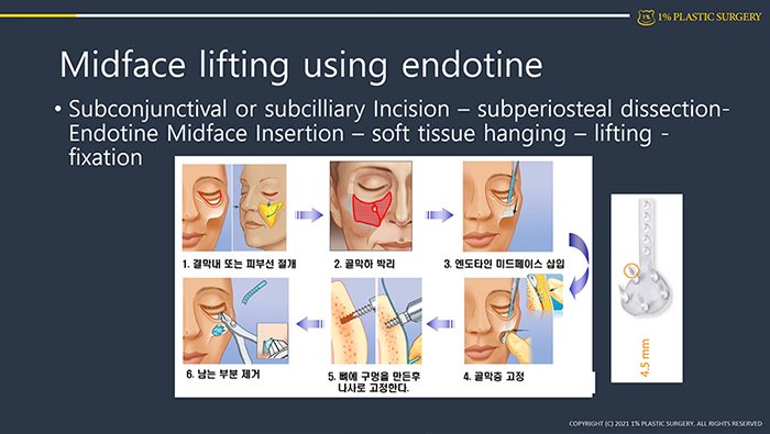 발표 슬라이드 Midface lifting using endotine(수술 과정 도식)