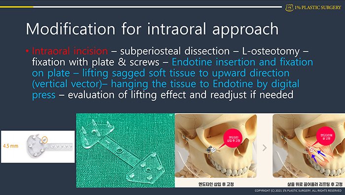 발표 슬라이드 Modification for intraoral approach(엔도타인·두개골 도식)