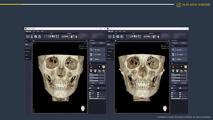 사례 슬라이드: 3D CT 두개골 전후 비교 1