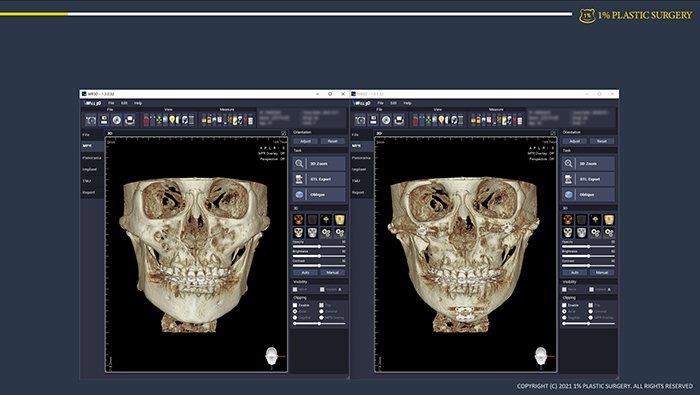 사례 슬라이드: 3D CT 두개골 전후 비교 2