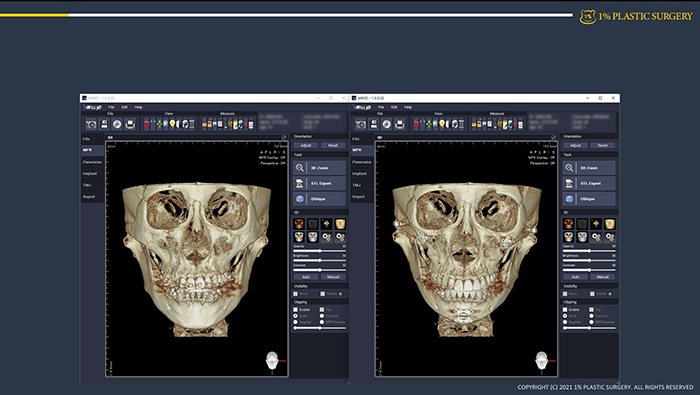 사례 슬라이드: 3D CT 두개골 전후 비교 3