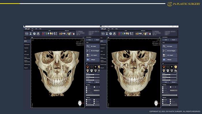 사례 슬라이드: 3D CT 두개골 전후 비교 4