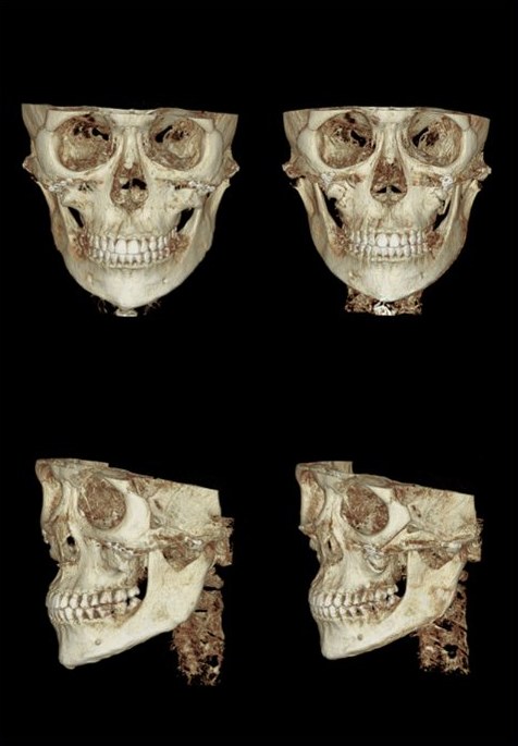 1. Less effect — 광대 재수술 전후 3D CT(정면·측면)