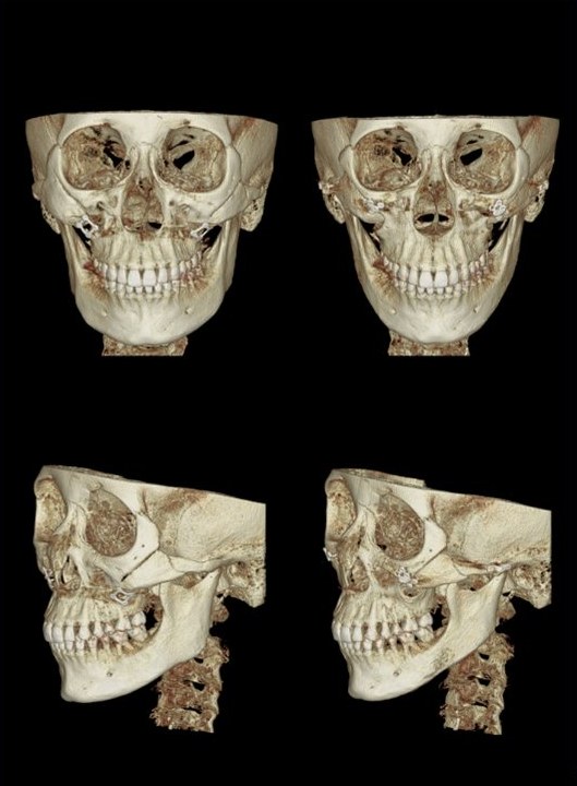 2. Asymmetry — 광대 비대칭 재수술 전후 3D CT(정면·측면)