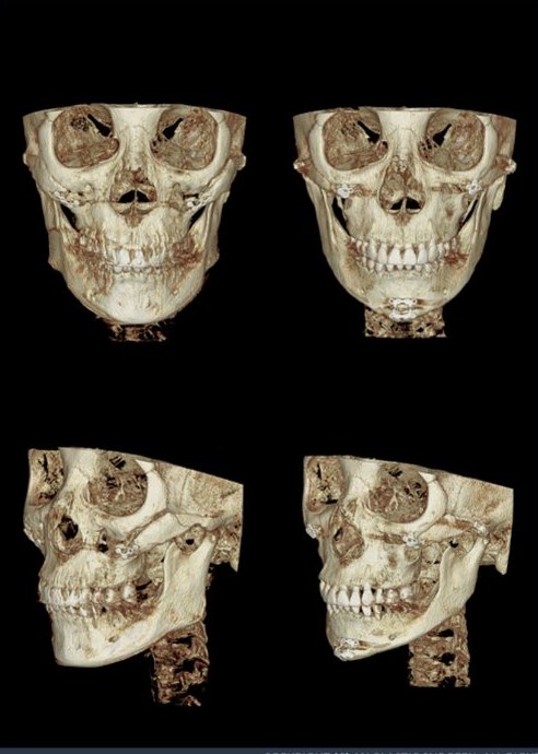 3. Nonunion/Malunion — 광대 불유합 재수술 전후 3D CT(정면·측면)