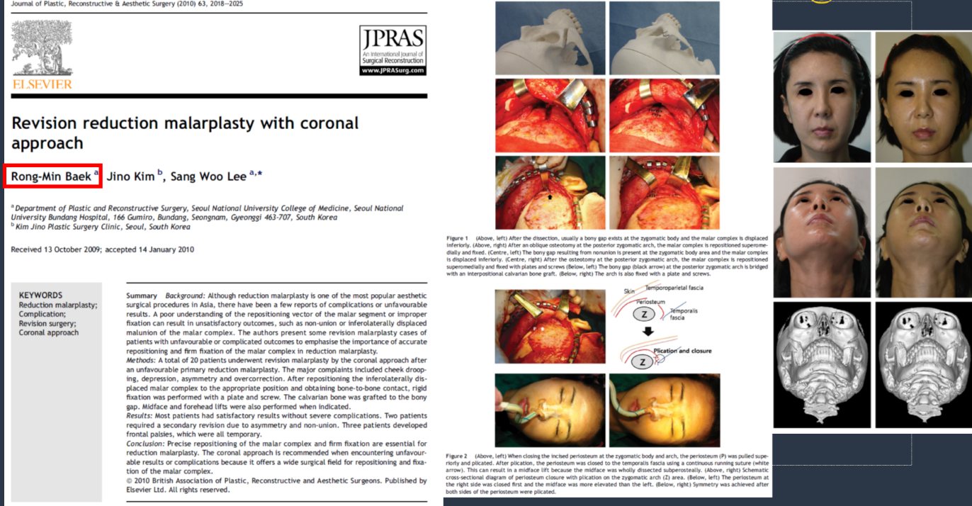 백롱민 교수 논문 'Revision reduction malarplasty with coronal approach'(JPRAS 2010) 지면과 수술·전후 사진