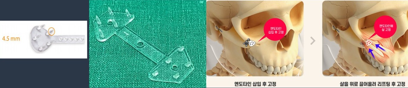 엔도타인(4.5 mm) 실물과 엔도타인 삽입 후 고정·살을 위로 끌어올려 리프팅 후 고정 일러스트