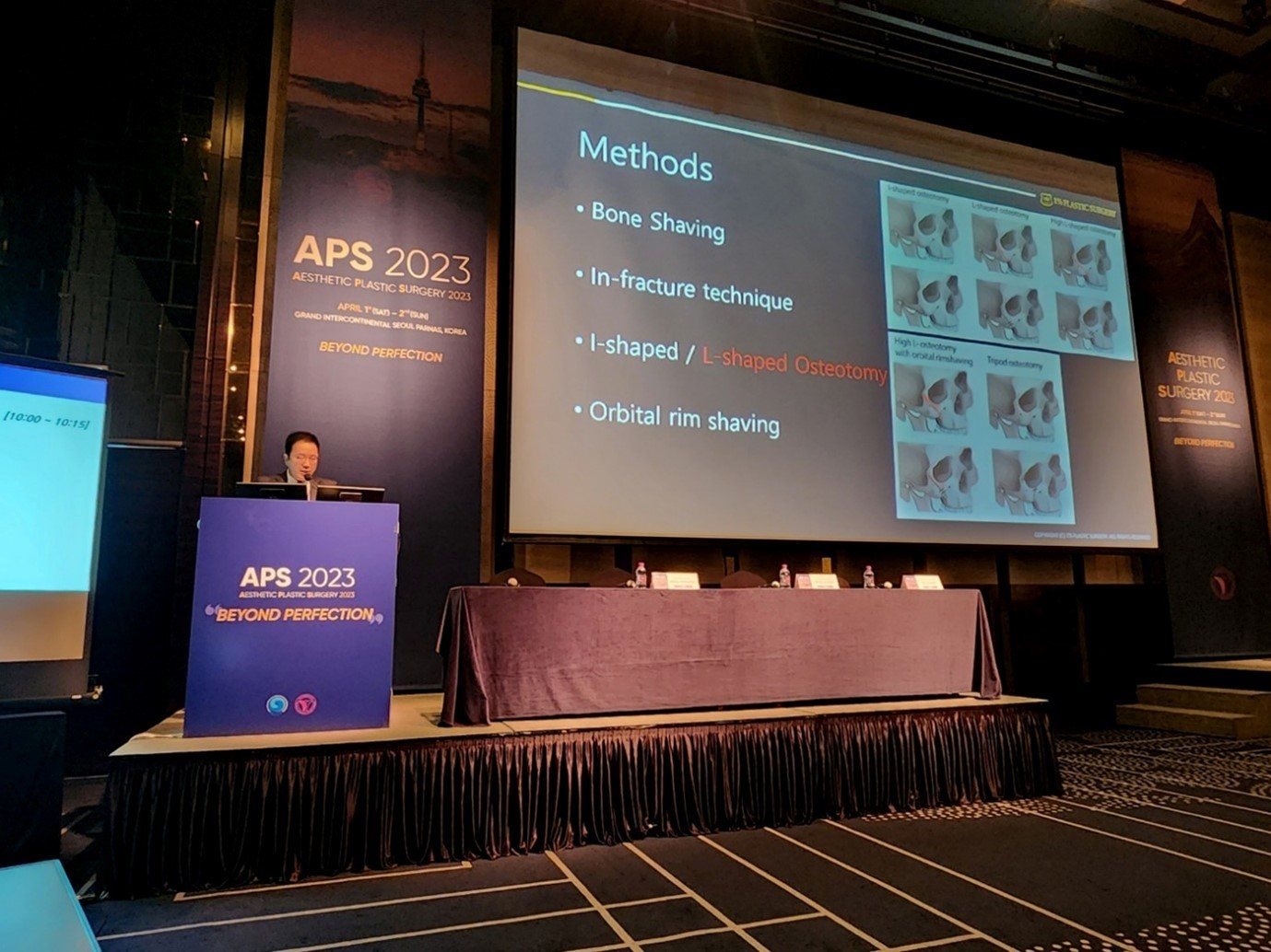 발표 장면 — 'Methods: Bone Shaving, In-fracture technique, I-shaped / L-shaped Osteotomy, Orbital rim shaving' 슬라이드