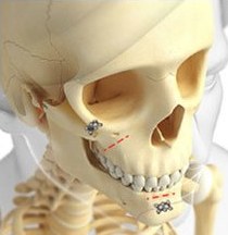 두개골 모형 — 입안·구레나룻 절개 부위 표시(01 입안 또는 구레나룻 절개)