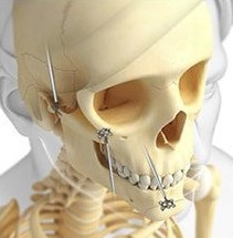두개골 모형 — 광대·앞턱 고정핀을 빼내는 모습(02 핀제거)
