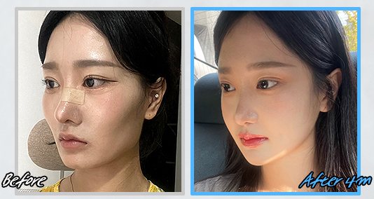 광대수술 전후 CASE 3(Before / After 4m)