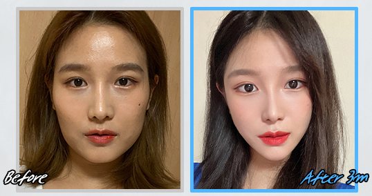 광대수술 전후 CASE 4(Before / After 3m)