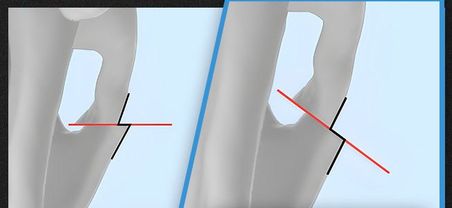 일반 수직 절골법과 1% 사선 절골 비교 도식(광대뼈 절골선)