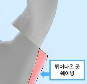 사선 절골 후 튀어나온 곳 쉐이빙 부위 표시 도식(1% 쉐이빙 Point)