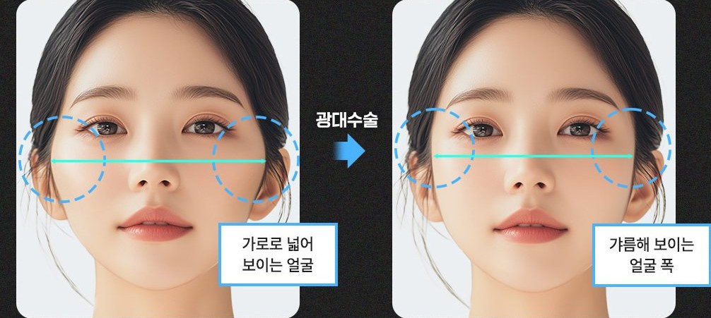 광대수술 전후 비교 일러스트 — 가로로 넓어 보이는 얼굴 → 광대수술 → 갸름해 보이는 얼굴 폭(광대 점선 원·가로선 표시)