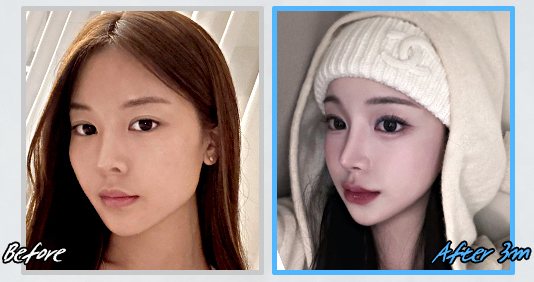 광대수술 전후 CASE 1(Before / After 3m)