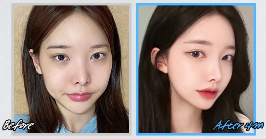 광대수술 전후 CASE 2(Before / After 4m)