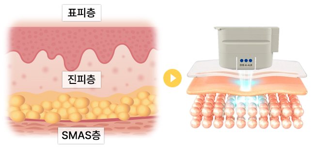 피부층 단면(표피층·진피층·SMAS층)과 울쎄라 팁이 피부 속에 에너지를 전달하는 그림