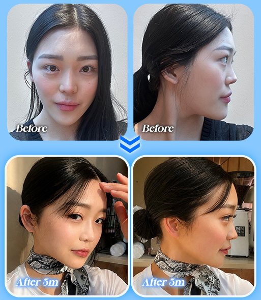 양악+윤곽 전후 사진 CASE 1(정면·측면 Before / After 3m)